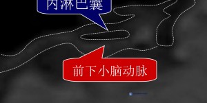 台湾耳鸣眩晕权威警示:「内淋巴囊血管压迫症」让医师也中招,当心这些症状