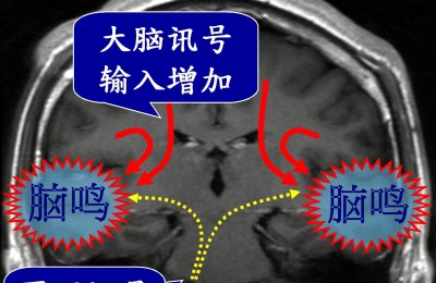 60岁主妇常听见”耳边乐曲” 台湾耳鸣权威诊治发现:原来是罕见脑鸣症
