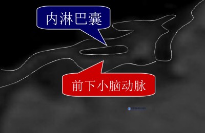 台湾耳鸣眩晕权威警示:「内淋巴囊血管压迫症」让医师也中招,当心这些症状