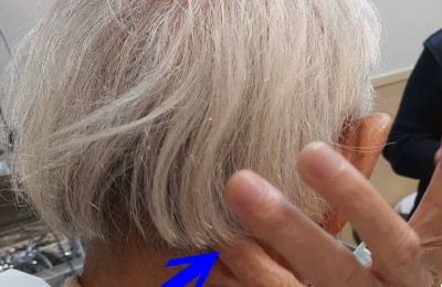 台湾耳鸣眩晕权威分享特殊病例:口腔溃疡引发的神经性偏头痛